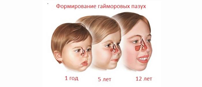 симптомы и лечение катарального гайморита у детей