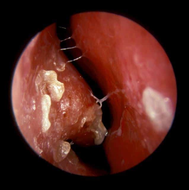 симптомы и лечение катарального ринита