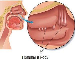 причины отека носа без насморка