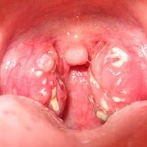 Как лечить туберкулез горла