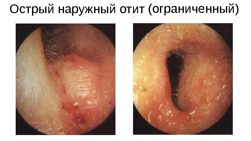 наружный отит