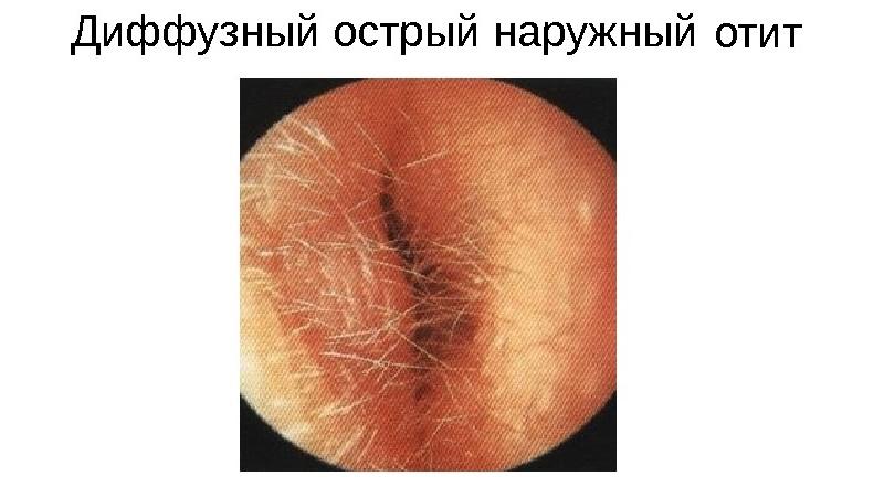 лечение наружного отита у детей