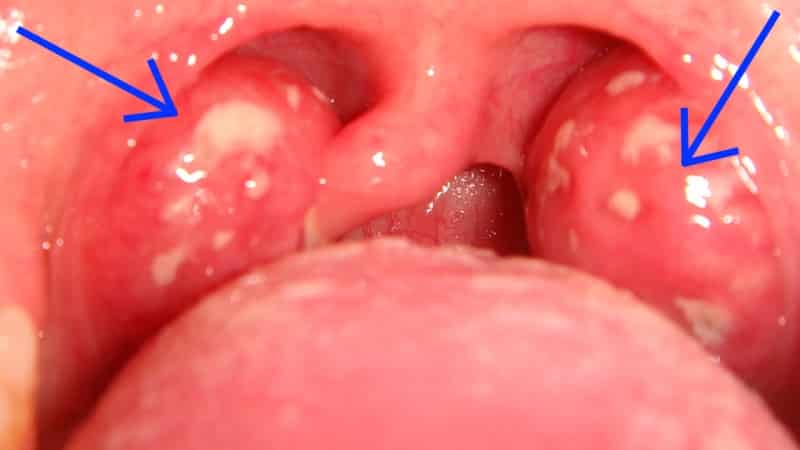 Как передается гнойная ангина