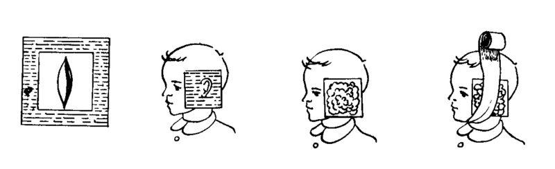 спиртовой компресс на ухо