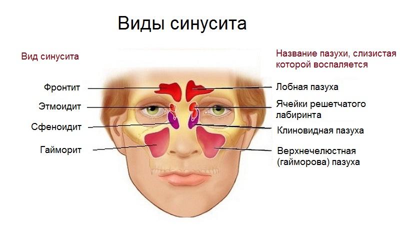 острый гнойный синусит