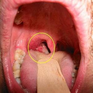 симптомы и лечение рака носоглотки