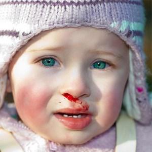 лечение слабых сосудов в носу