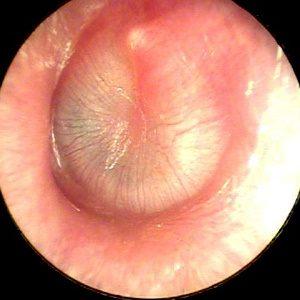 острый отит уха