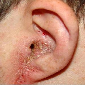 что такое острый отит