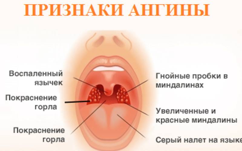 Какие антибиотики пить при гнойной ангине?