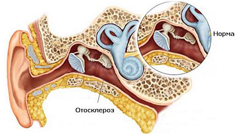 чем лечить воспаление среднего уха у взрослого