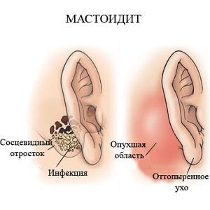 воспаление уха