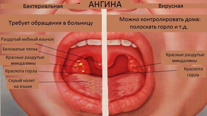 Какие бывают заболевания горла