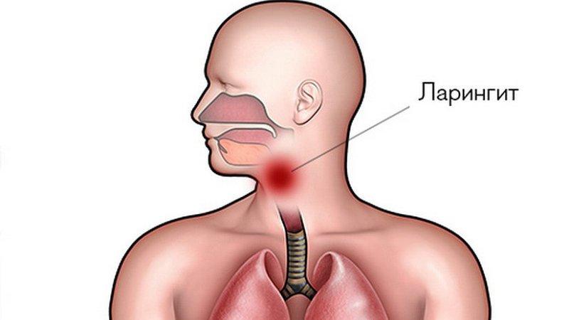 Какие бывают заболевания горла