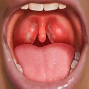 Какие осложнения могут быть после ангины