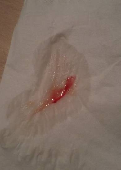 сопли с кровью при гайморите