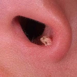 что капать в нос при аденоидах ребенку