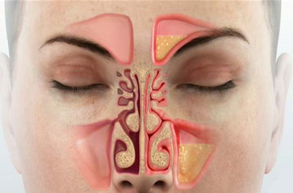 капли в нос при гайморите с антибиотиком название