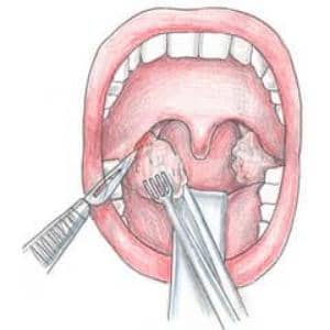 Что делать, если в горле шишки