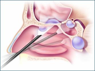 pravaya-verkhnechelyustnaya-pazukha-kista