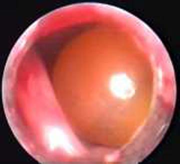 киста в носовой пазухе опасно ли это