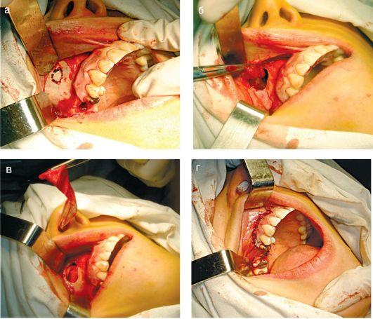операция по удалению кисты в носовой пазухе