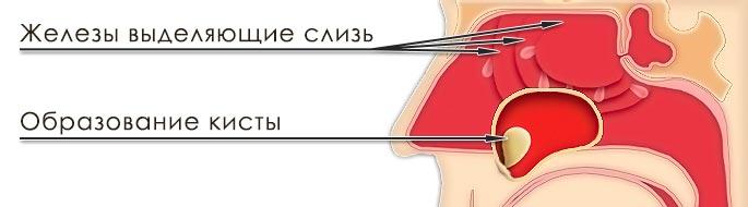 одонтогенная киста верхнечелюстной пазухи размеры для удаления