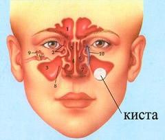 к чему может привести киста гайморовой пазухи симптомы лечение