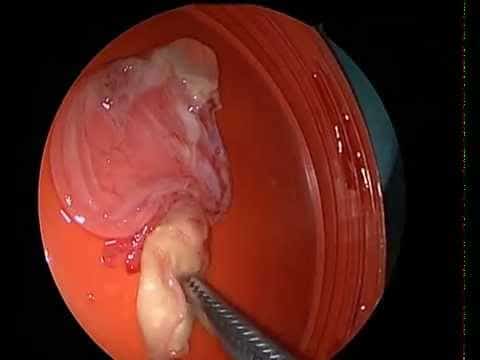 киста гайморовой пазухи фото