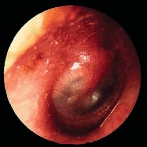 острый отит код по мкб 10
