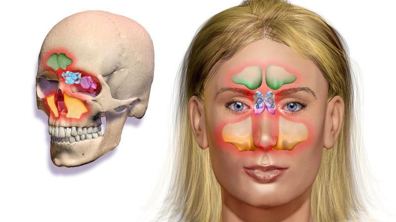 -как и чем лечить фронтит у взрослых