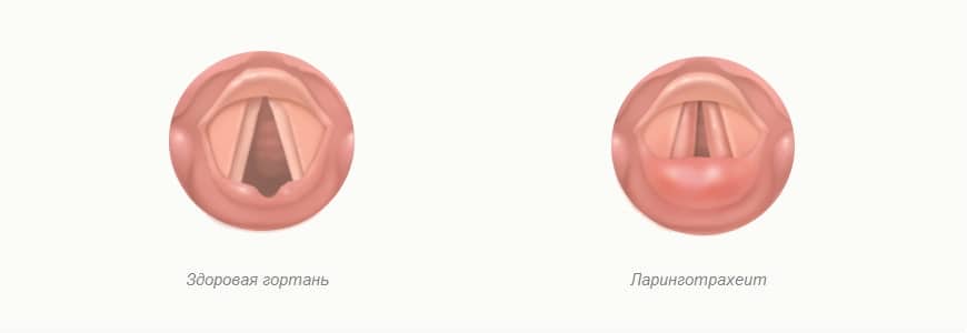 ларинготрахеит это