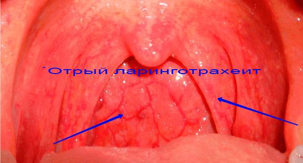 острый стенозирующий ларинготрахеит симптомы и лечение