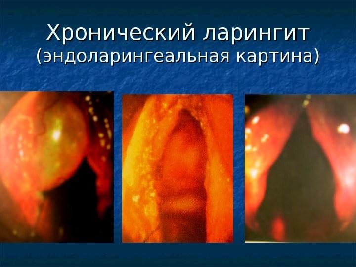 как и чем лечить ларинготрахеит у взрослых