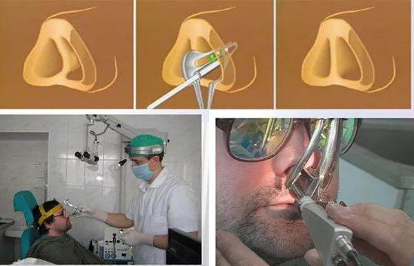 лазерная коррекция носовой перегородки