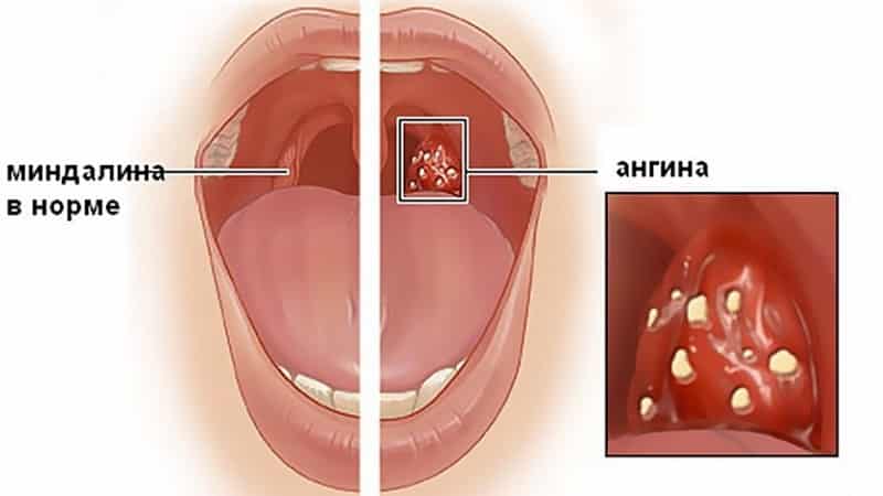 Какими народными средствами можно лечить гнойную ангину?