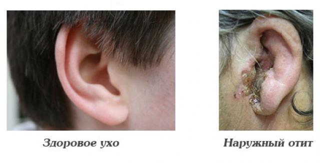 последствия отита у взрослых