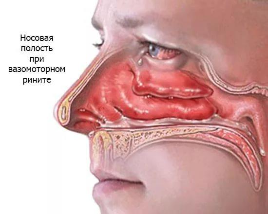 лечение вазомоторного ринита народными средствами