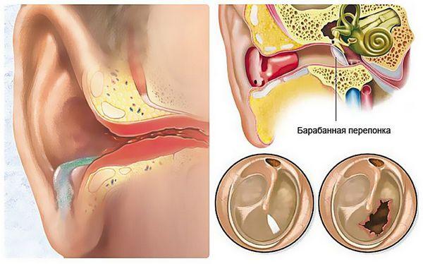 Лечение экссудативного отита у детей