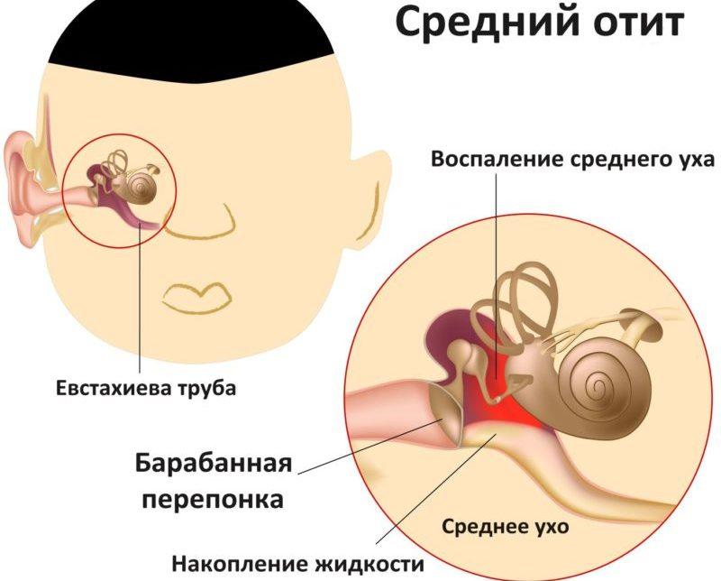 лечение отита у детей народными средствами