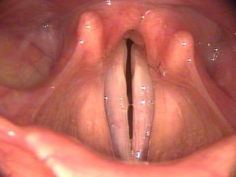 острый стенозирующий ларинготрахеит у детей лечение и симптомы