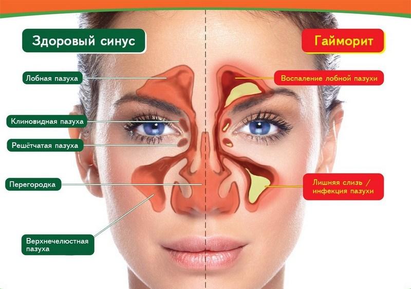 массаж лица при гайморите
