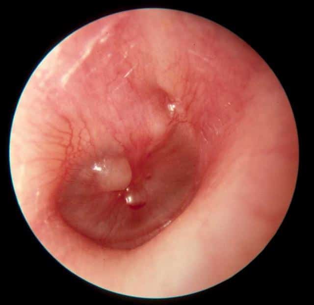 Что делать если шумит в ушах.