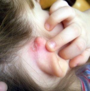 мокнет за ухом у взрослого