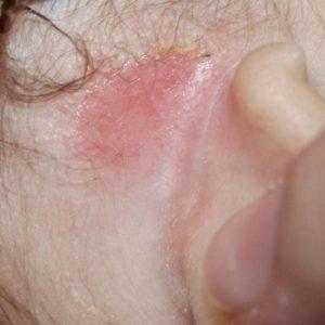 краснота за ухом