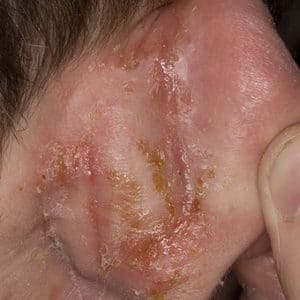 корочки на ушах у взрослых