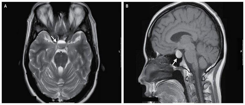 мрт околоносовых пазух
