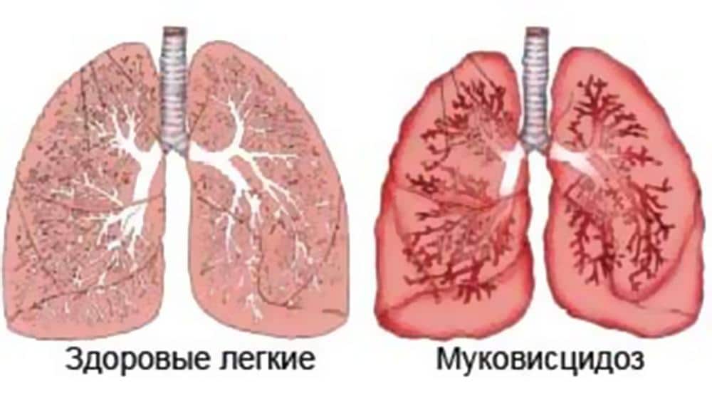 диагностика муковисцидоз