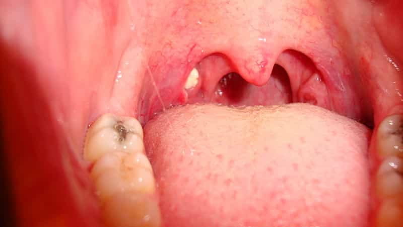 зловонные комочки