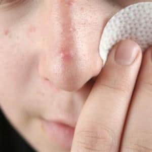 краснота под носом